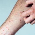 1 Santri di Meranti Diduga Terinfeksi Cacar Monyet Meninggal Dunia, Masyarakat Diimbau Tetap Tenang